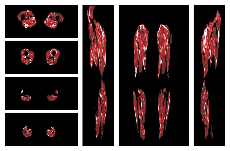 Muscle fiber tract density map based on whole leg DTI based fiber tractography.