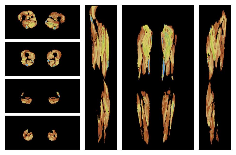 Muscle fiber tract length map based on whole leg DTI based fiber tractography.