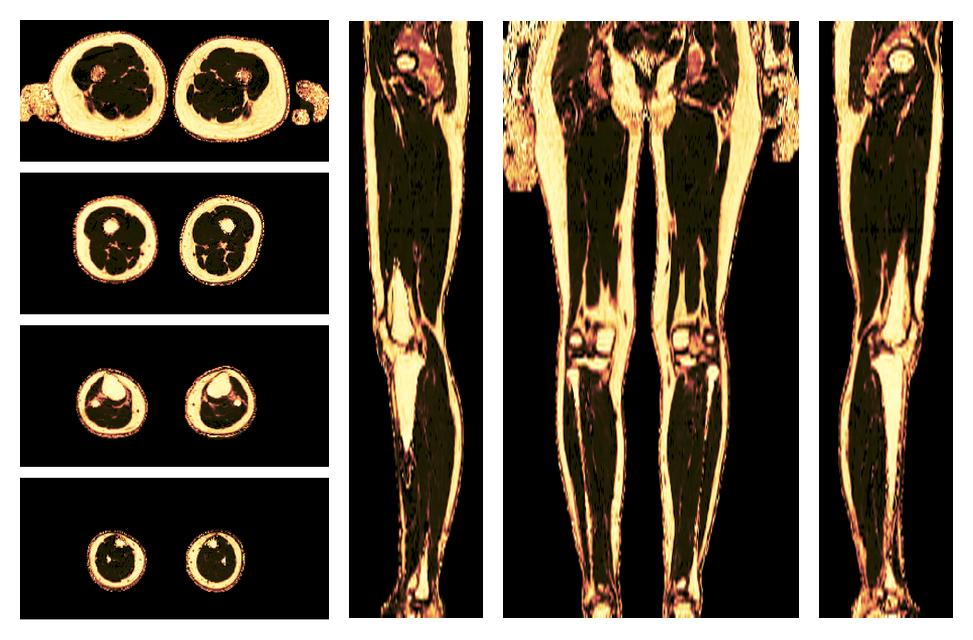 The fat fraction of the lower extremity obtained from the dixon reconstruction for muscle water fat quantification.