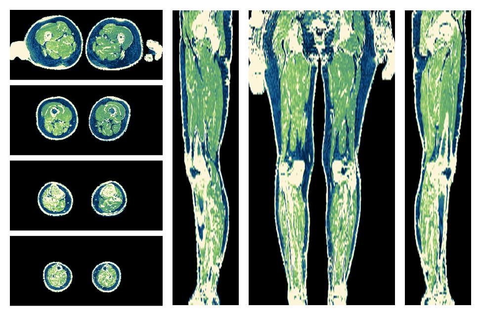 The R2 star relaxation time of the lower extremity obtained from the dixon reconstruction for muscle water fat quantification.