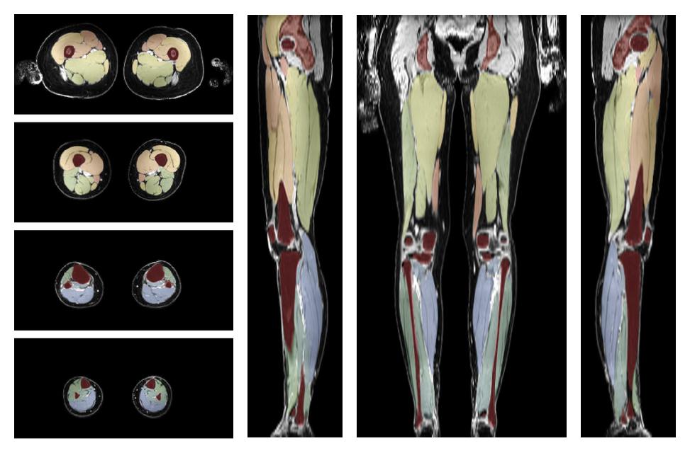 Overlay of automated muscle segmentation labels on dixon water image.