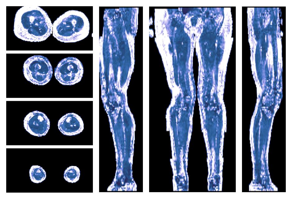 IVIM corrected whole leg muscle fractional anisotropy obtained from diffusion tensor imaging.