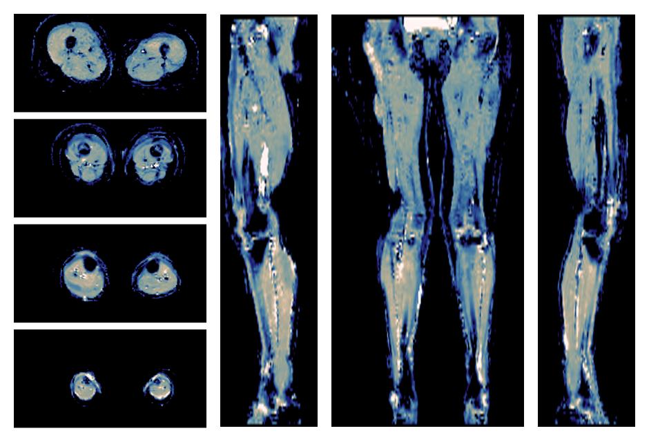 IVIM corrected whole leg muscle mean diffusivity obtained from diffusion tensor imaging.