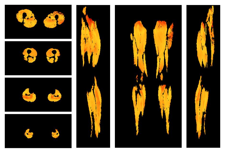 Muscle fiber tract angle map based on whole leg DTI based fiber tractography.