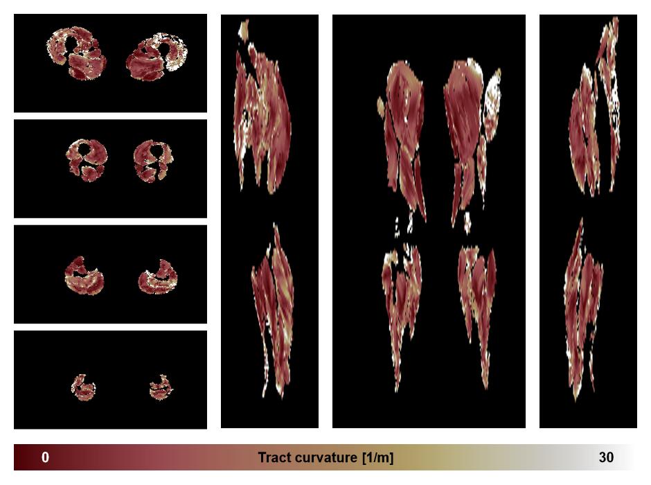 Muscle fiber tract curvature map based on whole leg DTI based fiber tractography.