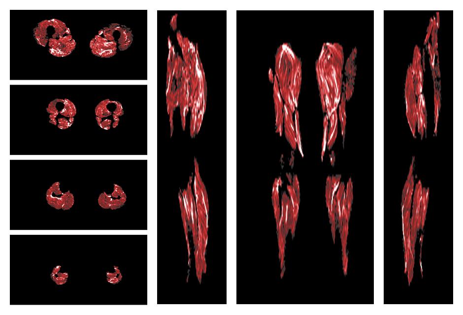 Muscle fiber tract density map based on whole leg DTI based fiber tractography.