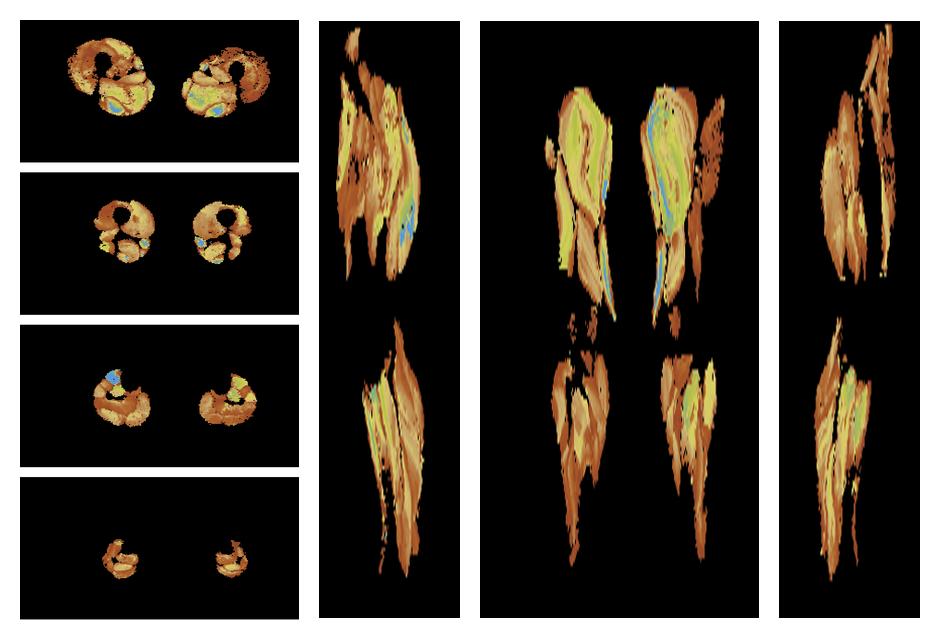 Muscle fiber tract length map based on whole leg DTI based fiber tractography.