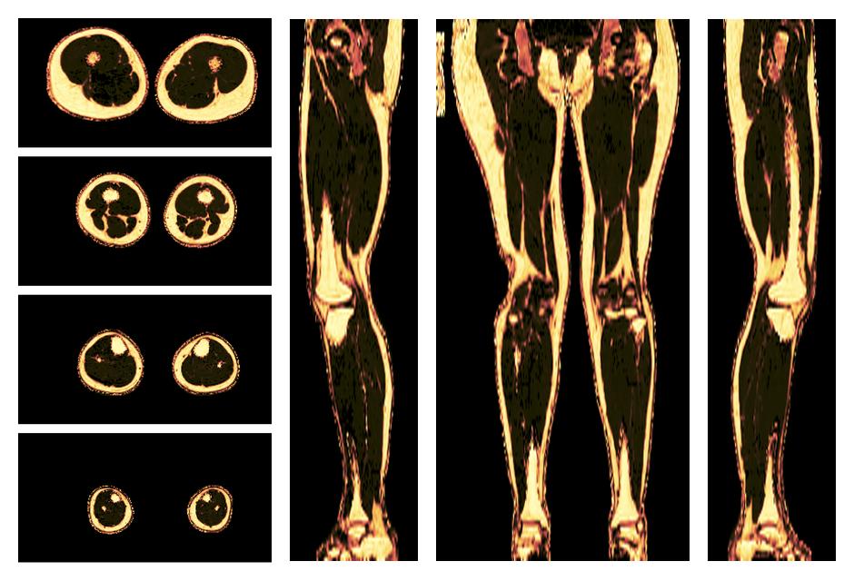 The fat fraction of the lower extremity obtained from the dixon reconstruction for muscle water fat quantification.