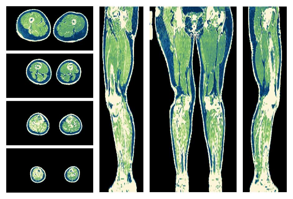 The R2 star relaxation time of the lower extremity obtained from the dixon reconstruction for muscle water fat quantification.