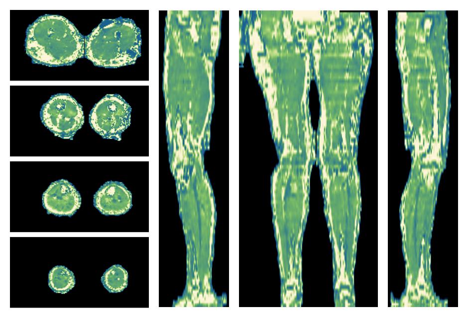 The water only T2 relaxation time of the lower extremity obtained from multi echo spin echo t2 mapping with EPG based reconstruction.