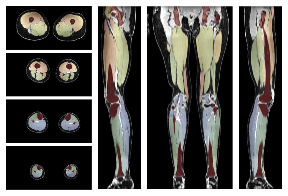 Overlay of automated muscle segmentation labels on dixon water image.