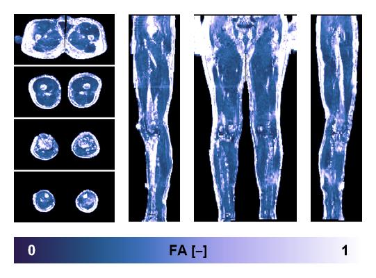 IVIM corrected whole leg muscle fractional anisotropy obtained from diffusion tensor imaging.