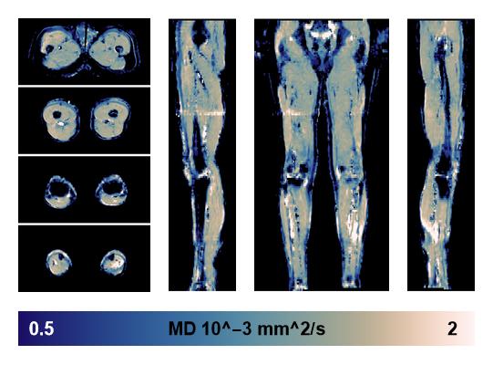 IVIM corrected whole leg muscle mean diffusivity obtained from diffusion tensor imaging.