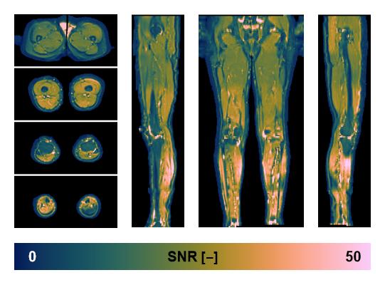 SNR distribution of the unweighted diffusion data.