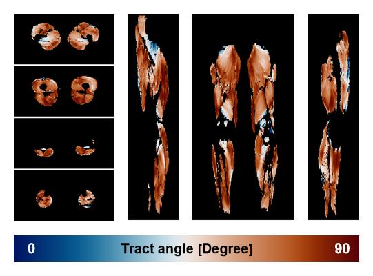 Muscle fiber tract angle map based on whole leg DTI based fiber tractography.