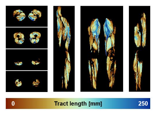 Muscle fiber tract length map based on whole leg DTI based fiber tractography.