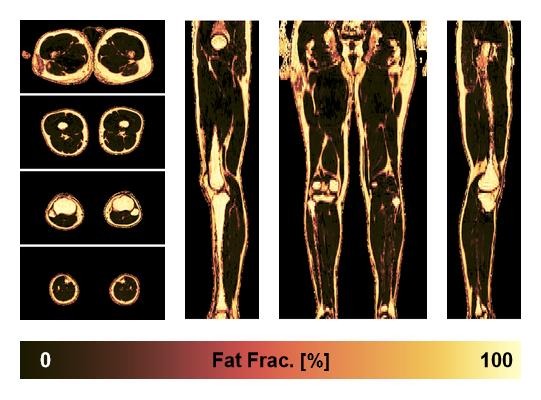 The fat fraction of the lower extremity obtained from the dixon reconstruction for muscle water fat quantification.