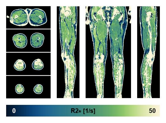 The R2 star relaxation time of the lower extremity obtained from the dixon reconstruction for muscle water fat quantification.