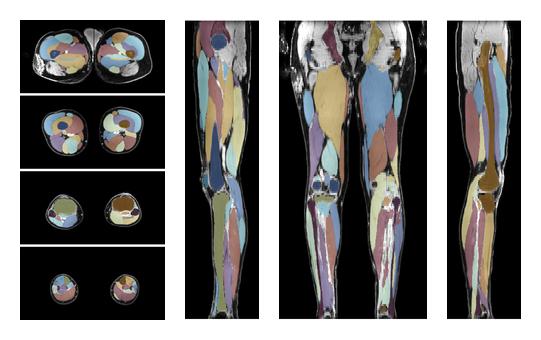 Overlay of automated muscle segmentation labels on dixon water image.