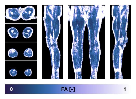 IVIM corrected whole leg muscle fractional anisotropy obtained from diffusion tensor imaging.