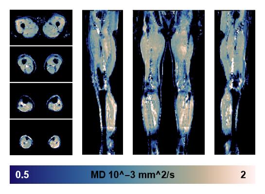 IVIM corrected whole leg muscle mean diffusivity obtained from diffusion tensor imaging.