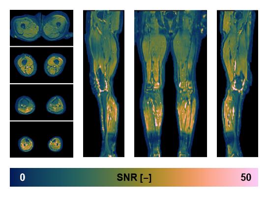 SNR distribution of the unweighted diffusion data.