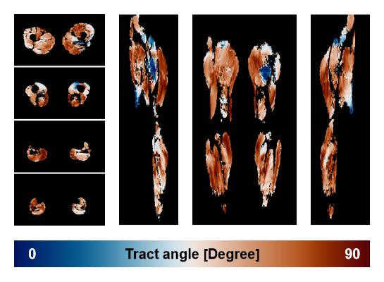 Muscle fiber tract angle map based on whole leg DTI based fiber tractography.