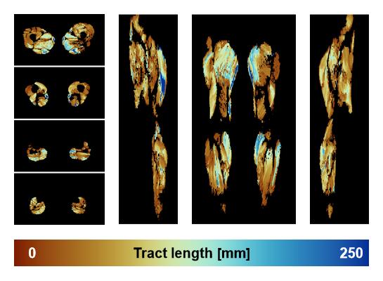 Muscle fiber tract length map based on whole leg DTI based fiber tractography.