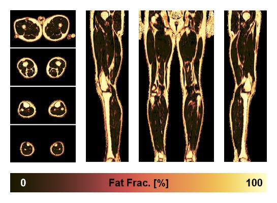 The fat fraction of the lower extremity obtained from the dixon reconstruction for muscle water fat quantification.