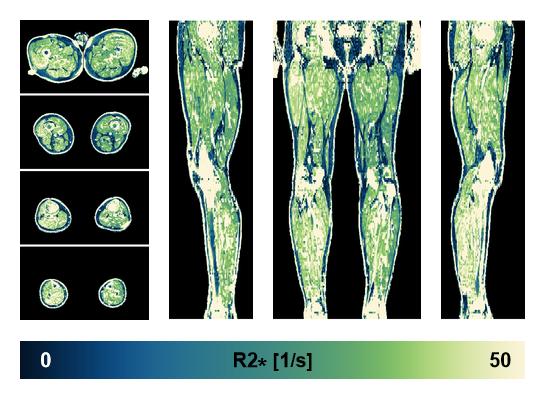 The R2 star relaxation time of the lower extremity obtained from the dixon reconstruction for muscle water fat quantification.