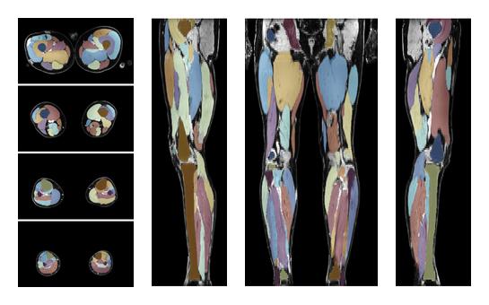 Overlay of automated muscle segmentation labels on dixon water image.