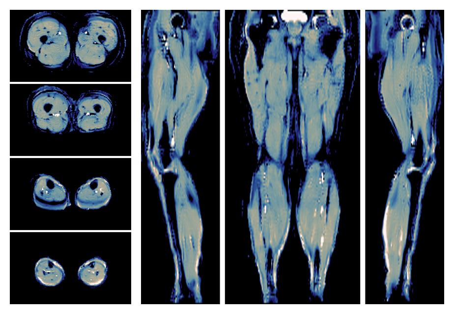 IVIM corrected whole leg muscle mean diffusivity obtained from diffusion tensor imaging.