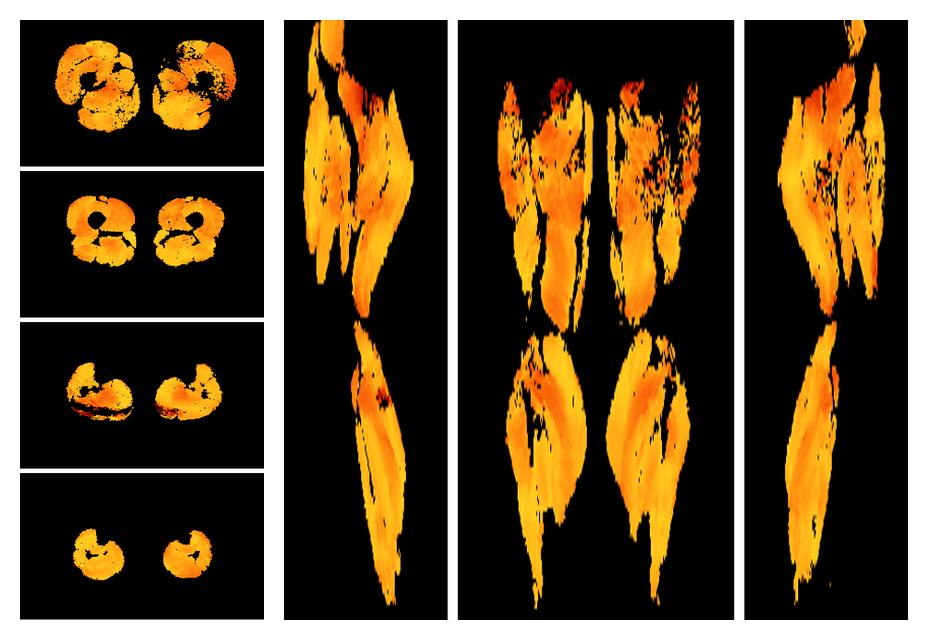 Muscle fiber tract angle map based on whole leg DTI based fiber tractography.