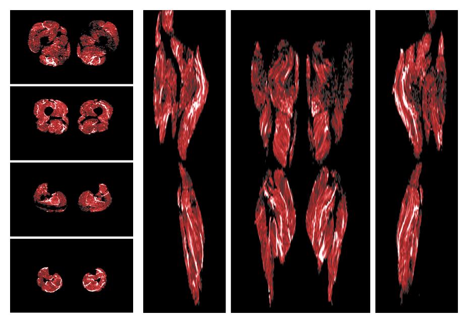 Muscle fiber tract density map based on whole leg DTI based fiber tractography.