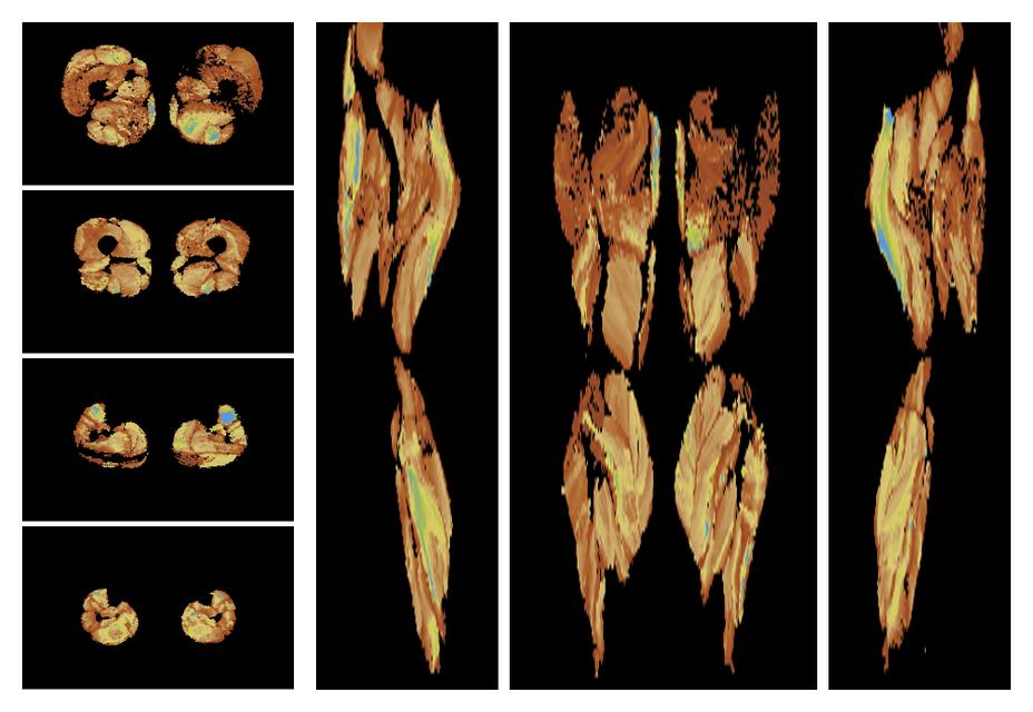 Muscle fiber tract length map based on whole leg DTI based fiber tractography.