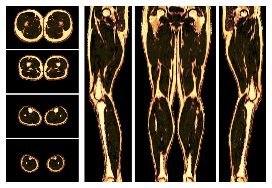 The fat fraction of the lower extremity obtained from the dixon reconstruction for muscle water fat quantification.