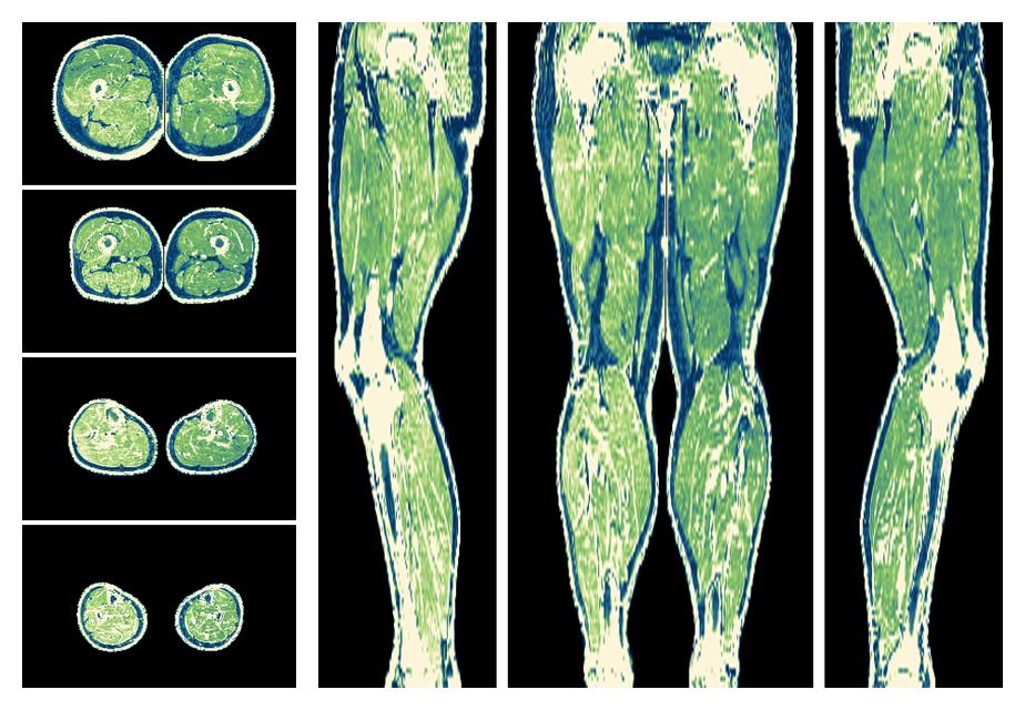 The R2 star relaxation time of the lower extremity obtained from the dixon reconstruction for muscle water fat quantification.