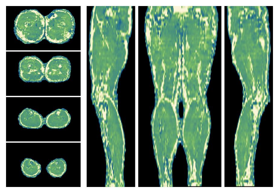 The water only T2 relaxation time of the lower extremity obtained from multi echo spin echo t2 mapping with EPG based reconstruction.