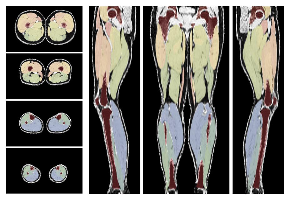 Overlay of automated muscle segmentation labels on dixon water image.