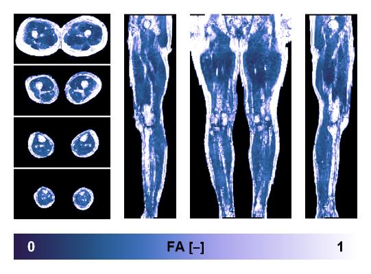 IVIM corrected whole leg muscle fractional anisotropy obtained from diffusion tensor imaging.