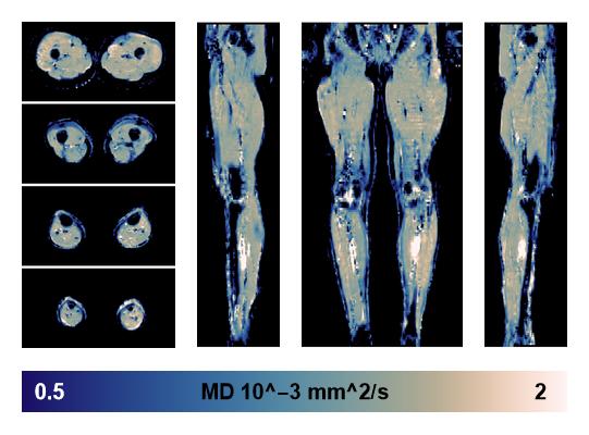 IVIM corrected whole leg muscle mean diffusivity obtained from diffusion tensor imaging.