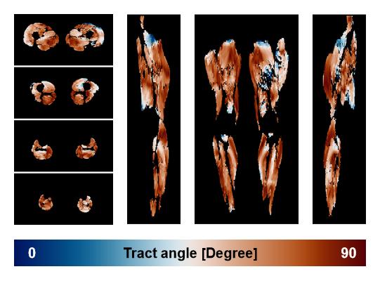 Muscle fiber tract angle map based on whole leg DTI based fiber tractography.