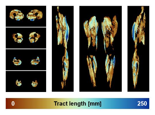 Muscle fiber tract length map based on whole leg DTI based fiber tractography.