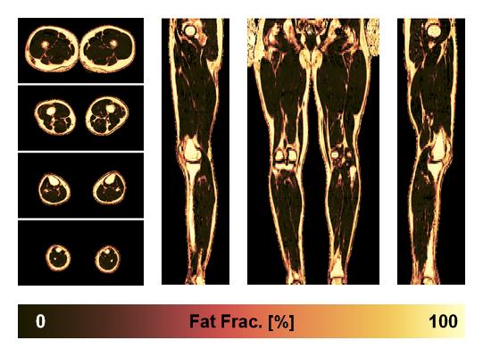 The fat fraction of the lower extremity obtained from the dixon reconstruction for muscle water fat quantification.