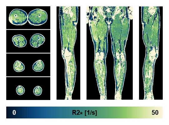 The R2 star relaxation time of the lower extremity obtained from the dixon reconstruction for muscle water fat quantification.