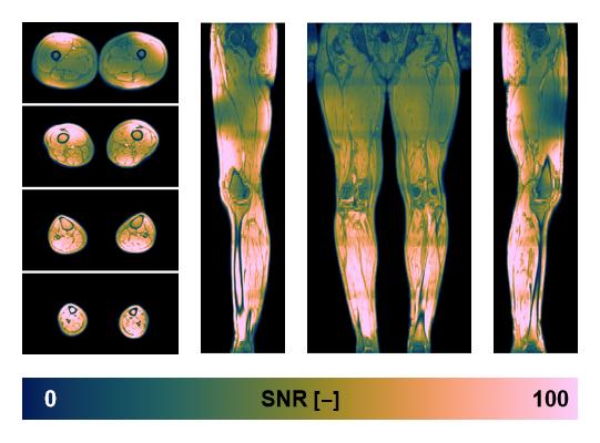 The SNR distribution of the dixon data.