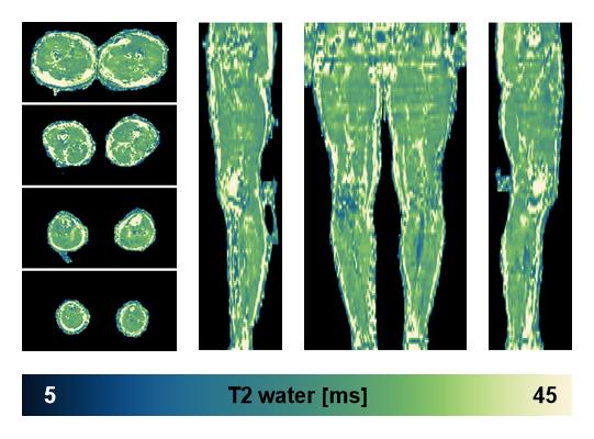 The water only T2 relaxation time of the lower extremity obtained from multi echo spin echo t2 mapping with EPG based reconstruction.