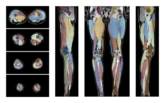 Overlay of automated muscle segmentation labels on dixon water image.