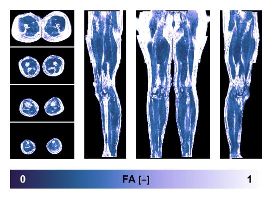 IVIM corrected whole leg muscle fractional anisotropy obtained from diffusion tensor imaging.