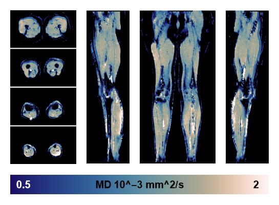 IVIM corrected whole leg muscle mean diffusivity obtained from diffusion tensor imaging.